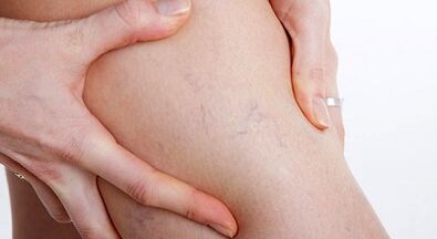 Признаци и симптоми на разширени вени