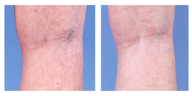 Козметична корекция