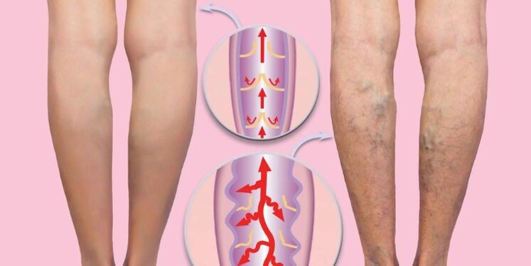здрави и разширени вени на краката